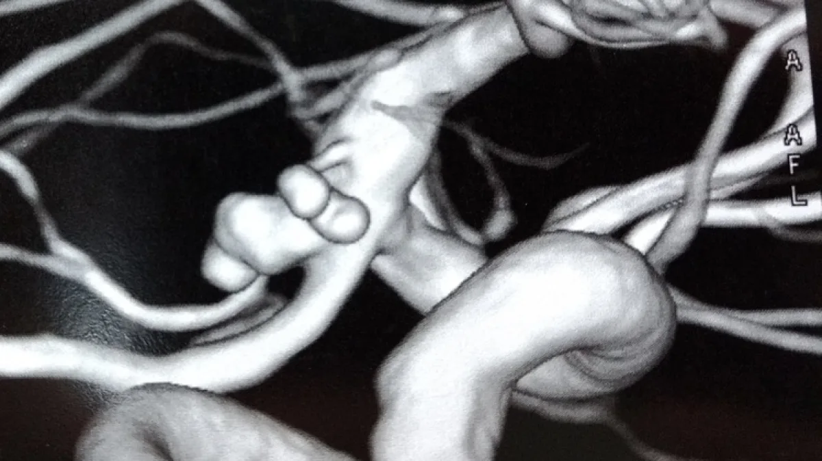 Imagem de angiografia mostrando aneurisma cerebral, exame usado para diagnosticar a dilatacao na parede da arteria